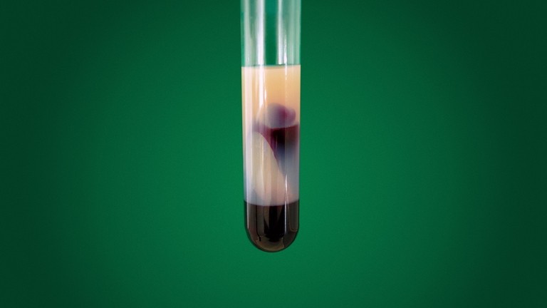 Muestra de sangre hiperlipemia